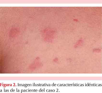 giardiasis urticaria